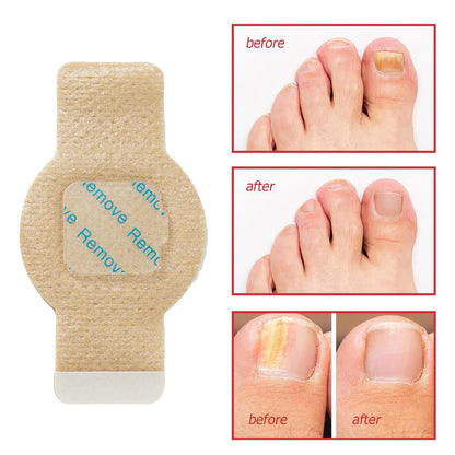 NailHeal Fungal Nail Patches - 7 Day Antifungal Treatment