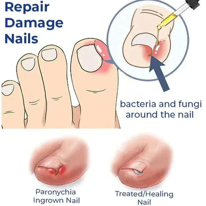 Anti Paronychia Nail Relief Oil - Natural Nail Infection Treatment