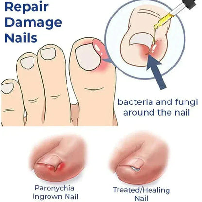 Anti Paronychia Nail Relief Oil - Natural Nail Infection Treatment