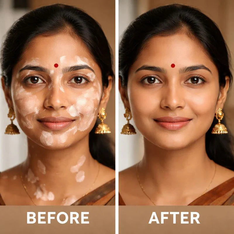 Bee Venom Vitiligo Correcting Cream - Pack of 2