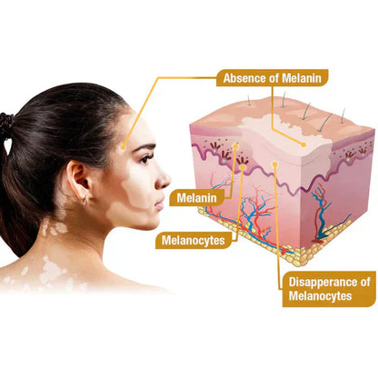 Bee Venom Vitiligo Correcting Cream - Pack of 2